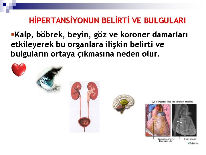 HİPERTANSİYONUN BELİRTİ VE BULGULARI §Kalp, böbrek, beyin, göz ve koroner damarları etkileyerek bu organlara