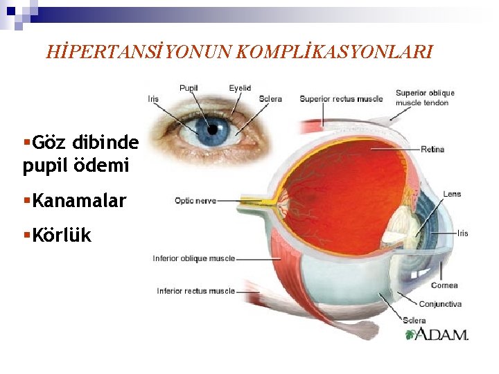 HİPERTANSİYONUN KOMPLİKASYONLARI §Göz dibinde pupil ödemi §Kanamalar §Körlük 