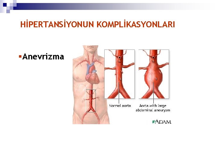 HİPERTANSİYONUN KOMPLİKASYONLARI §Anevrizma 