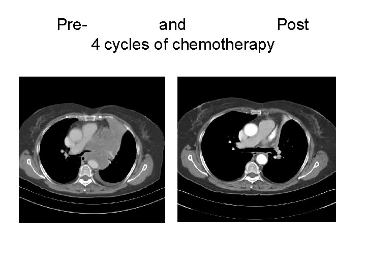 Pre- and Post 4 cycles of chemotherapy 