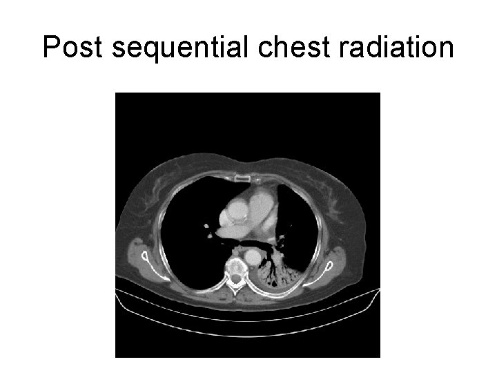 Post sequential chest radiation 