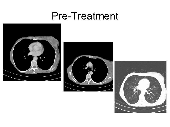 Pre-Treatment 