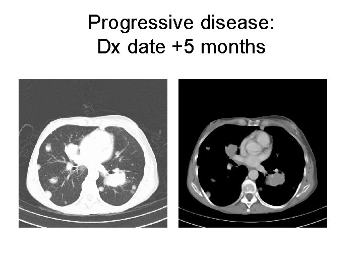Progressive disease: Dx date +5 months 