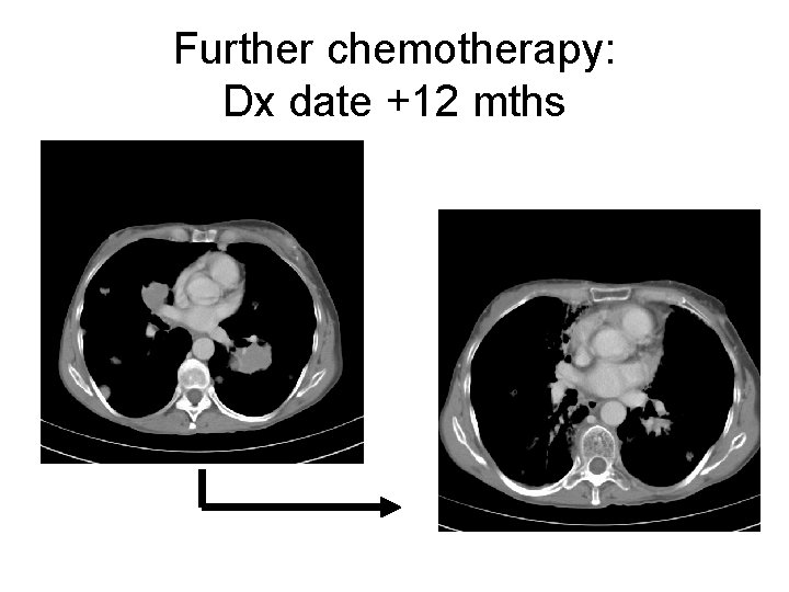 Further chemotherapy: Dx date +12 mths 