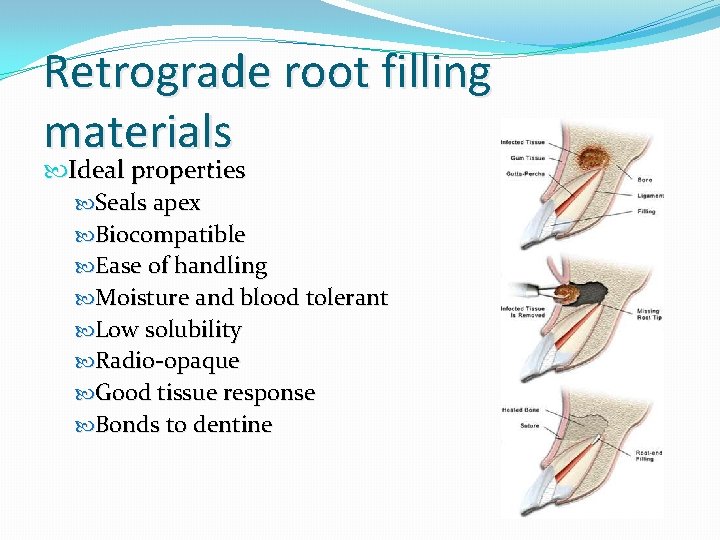 Retrograde root filling materials Ideal properties Seals apex Biocompatible Ease of handling Moisture and