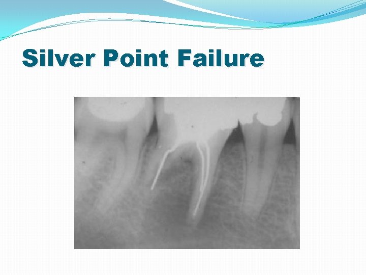 Silver Point Failure 
