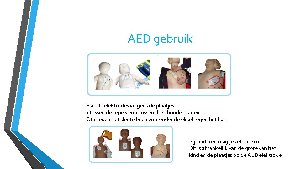 AED gebruik Plak de elektrodes volgens de plaatjes 1 tussen de tepels en 1