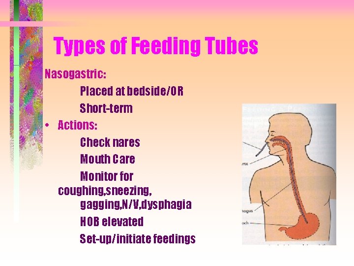 Types of Feeding Tubes Nasogastric: Placed at bedside/OR Short-term • Actions: Check nares Mouth