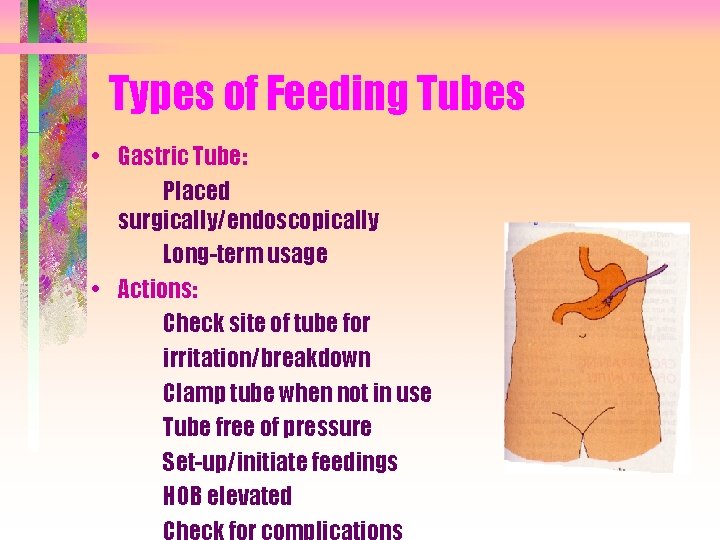Types of Feeding Tubes • Gastric Tube: Placed surgically/endoscopically Long-term usage • Actions: Check