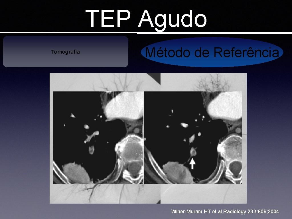 TEP Agudo Tomografia Método de Referência Winer-Muram HT et al. Radiology. 233: 806; 2004