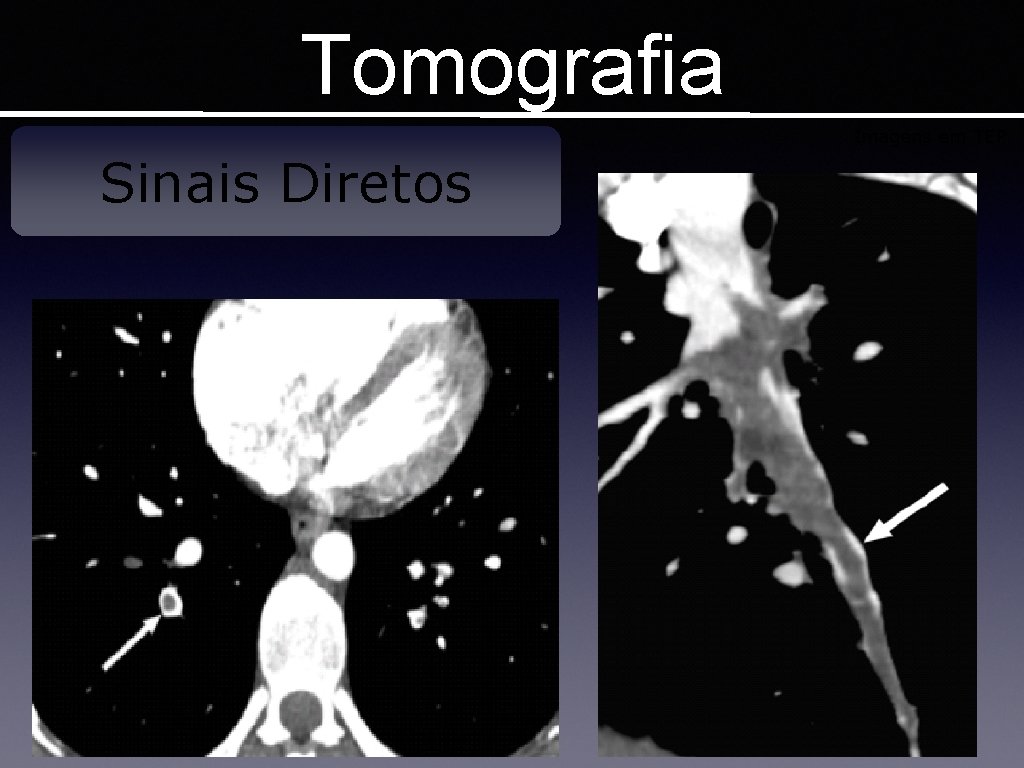 Tomografia Imagens em TEP Sinais Diretos 