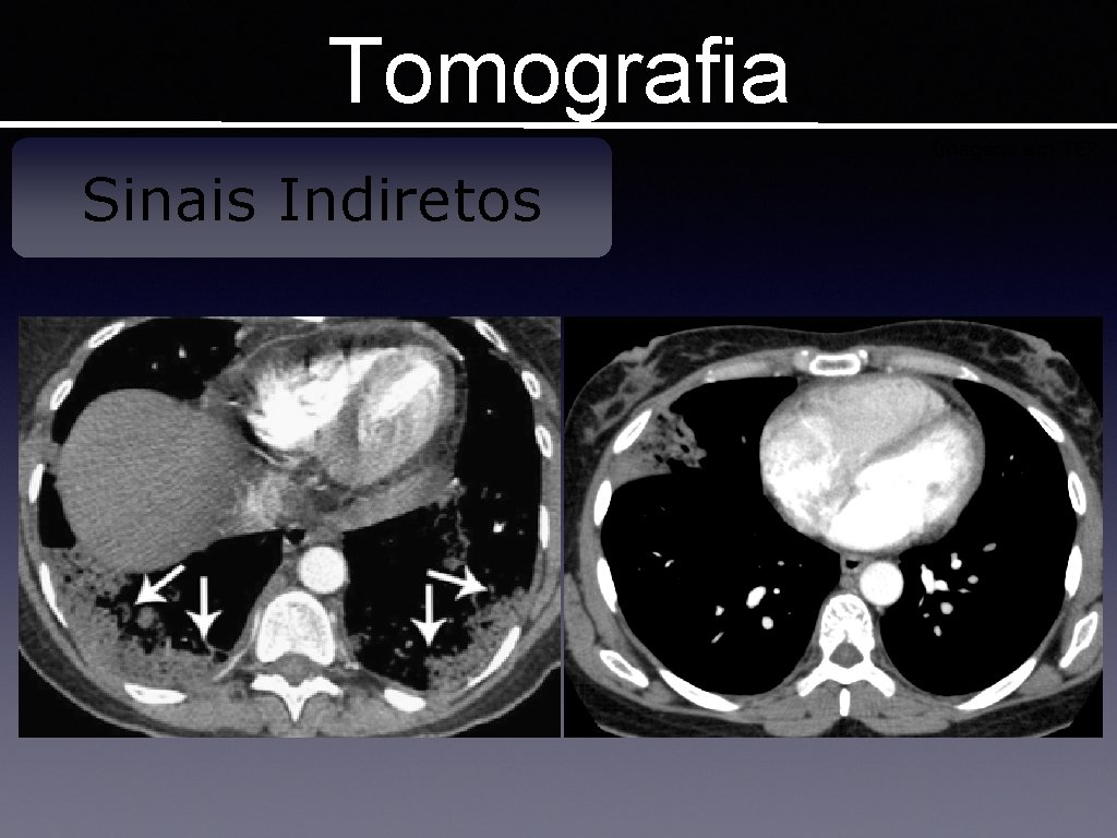 Tomografia Imagens em TEP Sinais Indiretos 