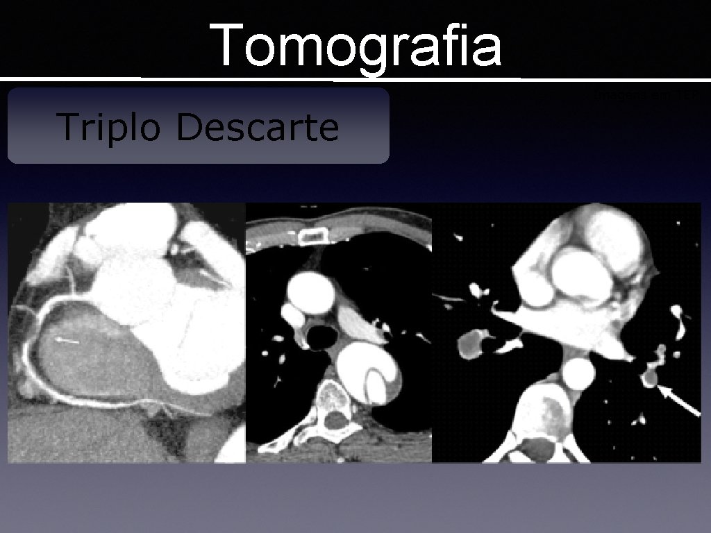 Tomografia Imagens em TEP Triplo Descarte 