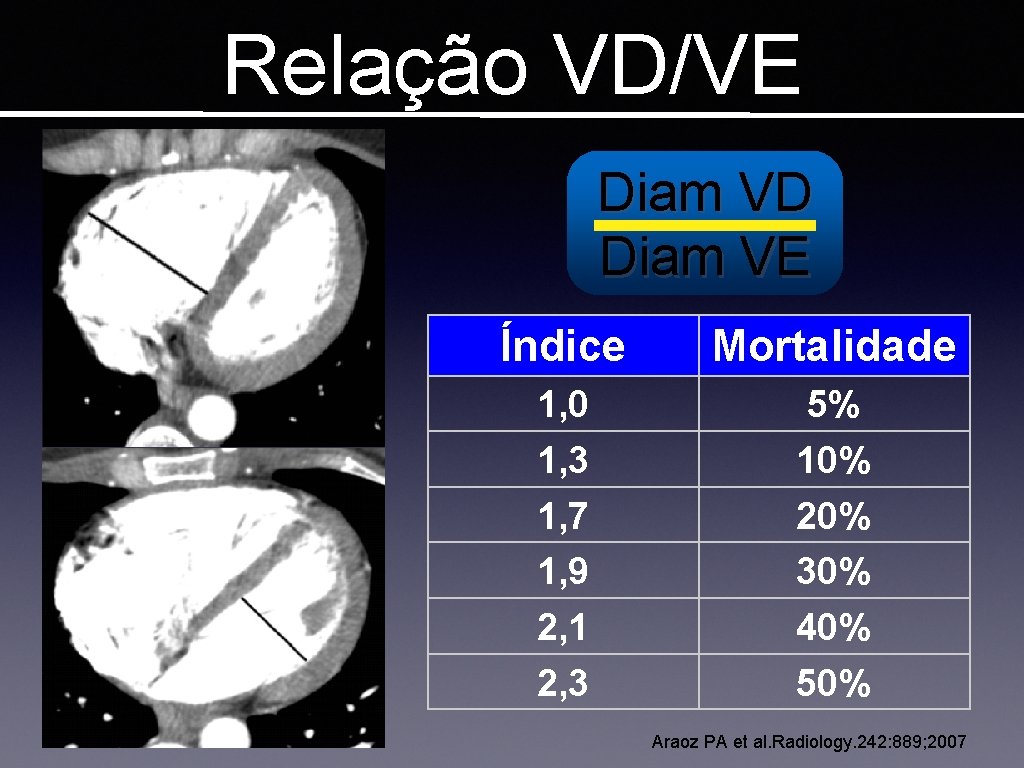 Relação VD/VE Diam VD Diam VE Índice Mortalidade 1, 0 1, 3 1, 7