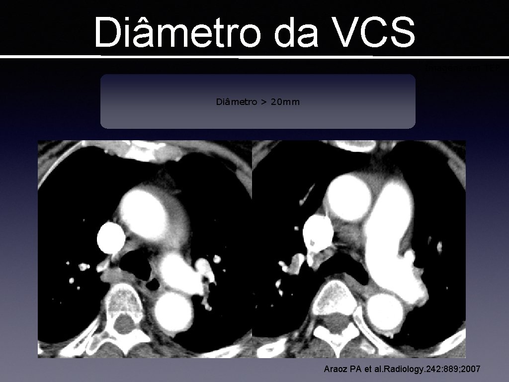 Diâmetro da VCS Imagens em TEP Diâmetro > 20 mm Araoz PA et al.