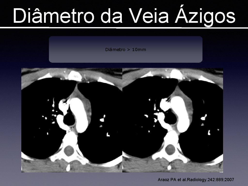 Diâmetro da Veia Ázigos Imagens em TEP Diâmetro > 10 mm Araoz PA et