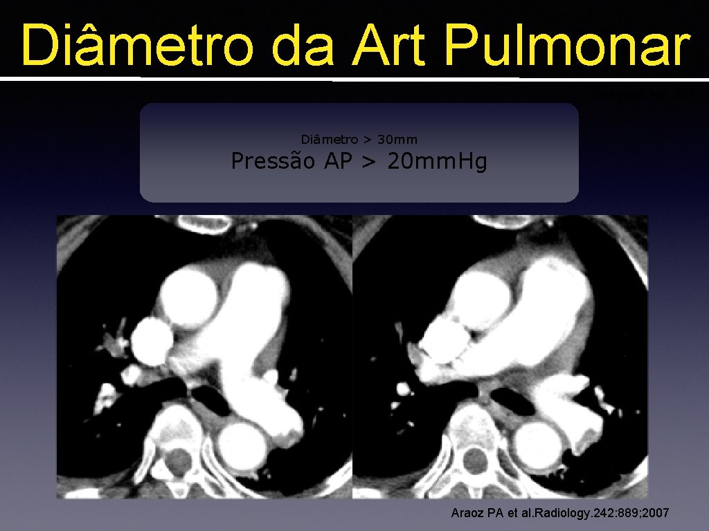 Diâmetro da Art Pulmonar Imagens em TEP Diâmetro > 30 mm Pressão AP >