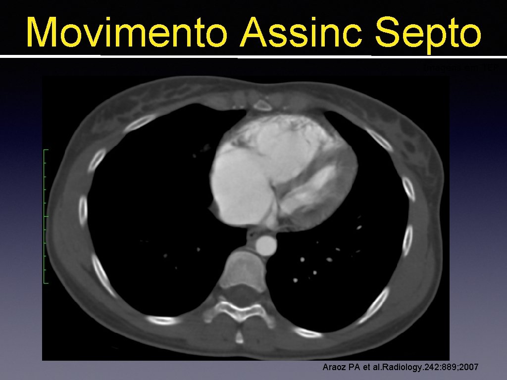 Movimento Assinc Septo Imagens em TEP Araoz PA et al. Radiology. 242: 889; 2007