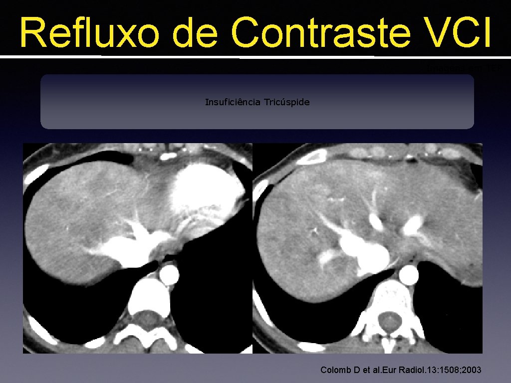 Refluxo de Contraste VCI Imagens em TEP Insuficiência Tricúspide Colomb D et al. Eur