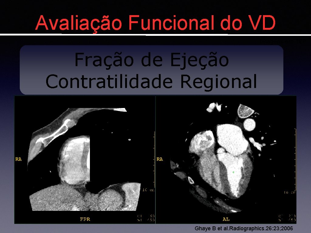 Avaliação Funcional do VD Imagens em TEP Fração de Ejeção Contratilidade Regional Ghaye B
