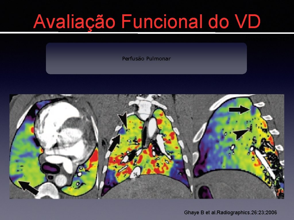 Avaliação Funcional do VD Imagens em TEP Perfusão Pulmonar Ghaye B et al. Radiographics.