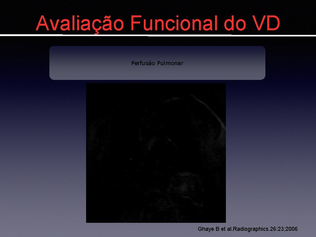 Avaliação Funcional do VD Imagens em TEP Perfusão Pulmonar Ghaye B et al. Radiographics.