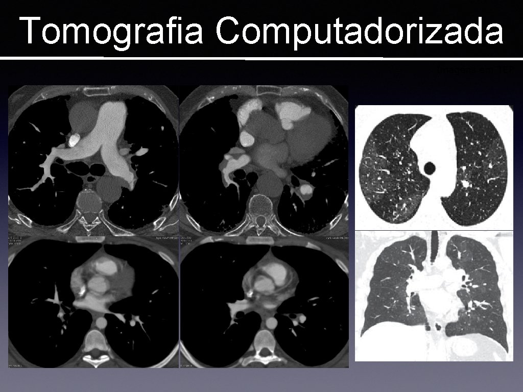 Tomografia Computadorizada Imagens em TEP 