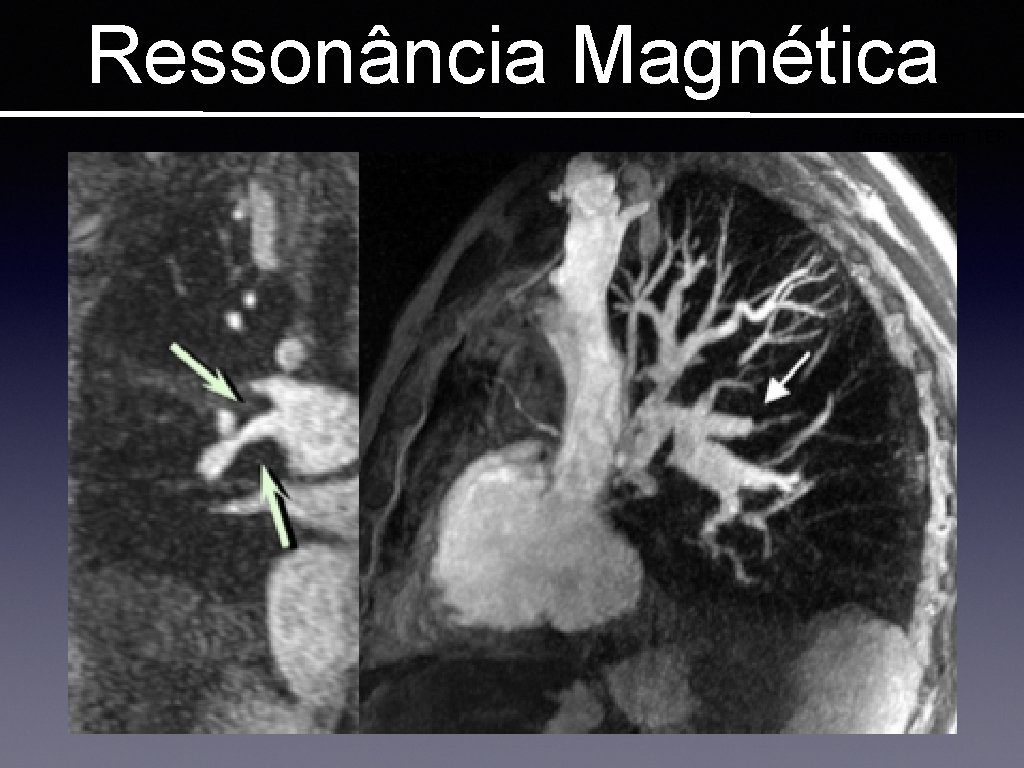 Ressonância Magnética Imagens em TEP 