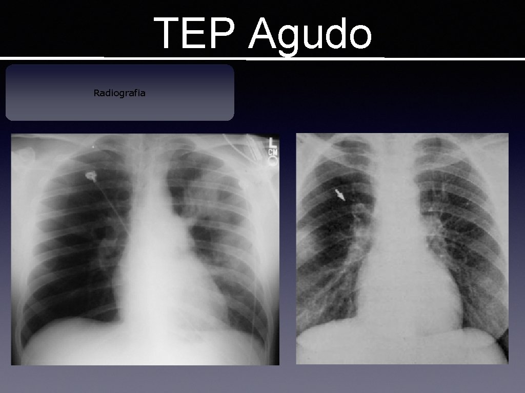 TEP Agudo Radiografia 