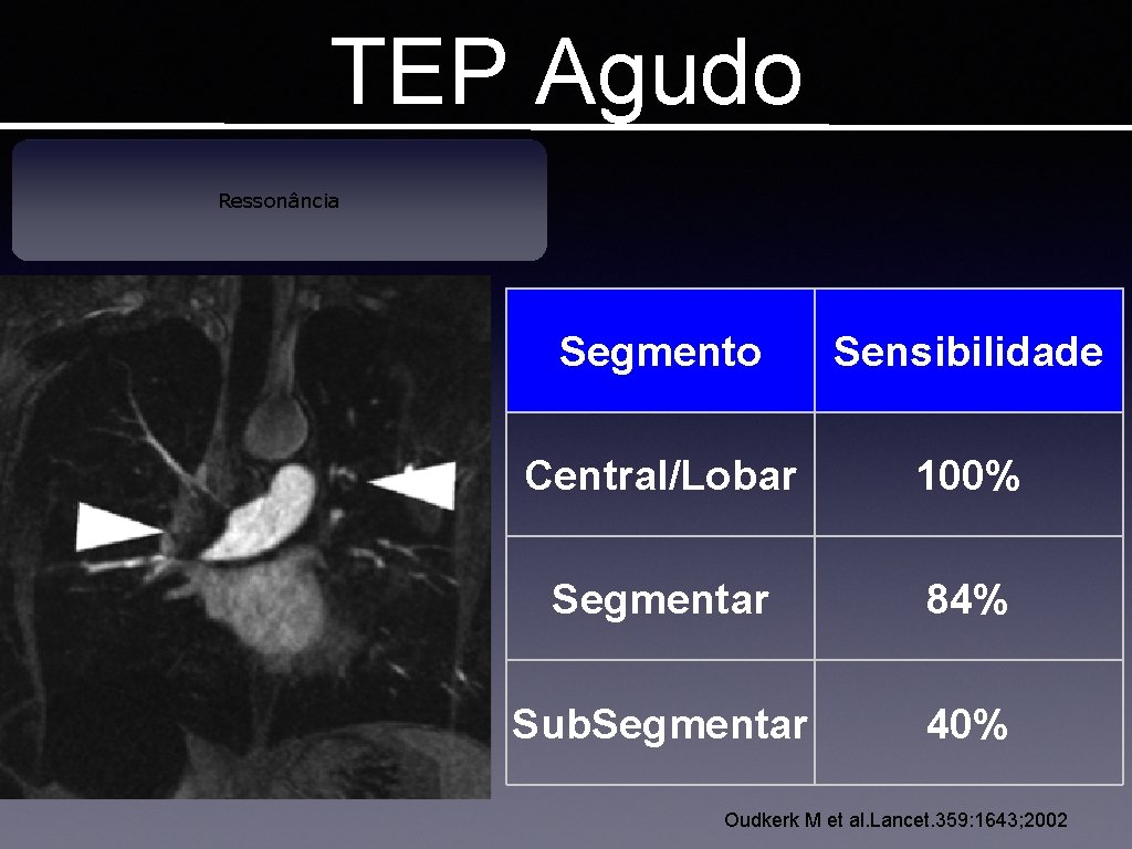 TEP Agudo Ressonância Segmento Sensibilidade Central/Lobar 100% Segmentar 84% Sub. Segmentar 40% Oudkerk M
