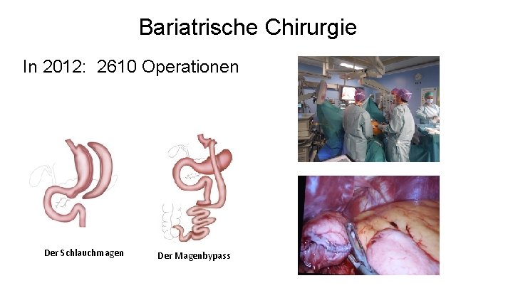 Bariatrische Chirurgie In 2012: 2610 Operationen Der Schlauchmagen Der Magenbypass 