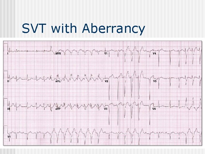 SVT with Aberrancy 