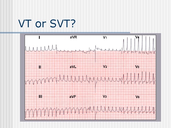 VT or SVT? 