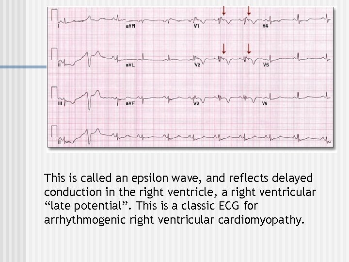  This is called an epsilon wave, and reflects delayed conduction in the right