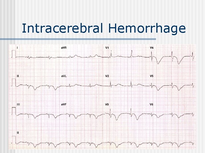 Intracerebral Hemorrhage 