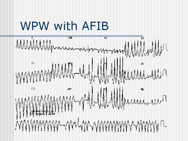 WPW with AFIB 
