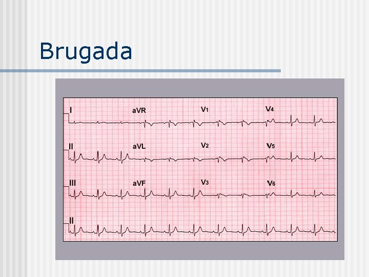 Brugada 