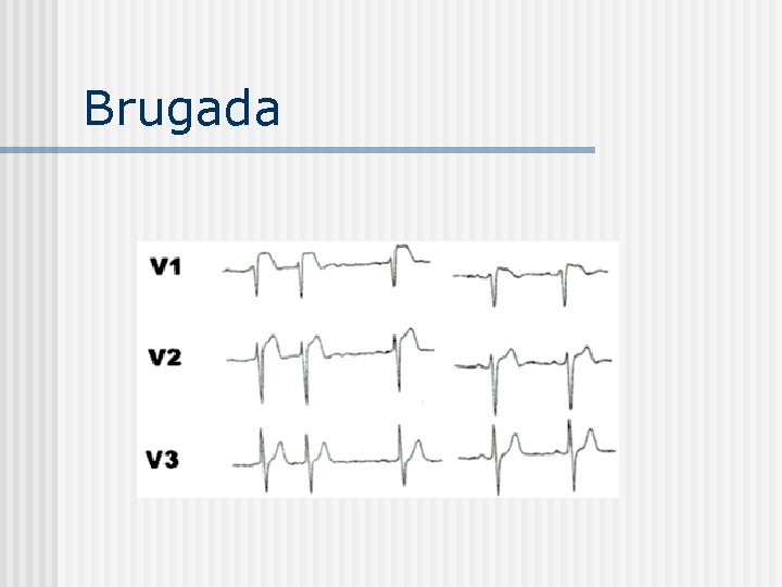 Brugada 