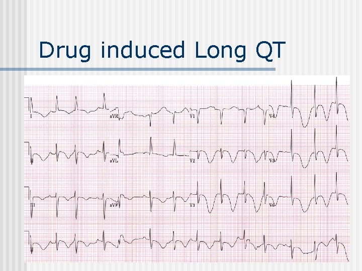 Drug induced Long QT 