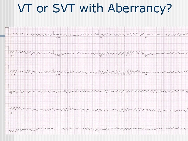 VT or SVT with Aberrancy? 