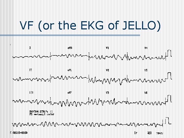 VF (or the EKG of JELLO) 