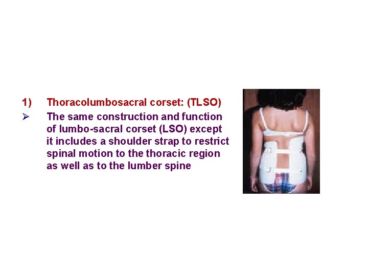 1) Ø Thoracolumbosacral corset: (TLSO) The same construction and function of lumbo-sacral corset (LSO)