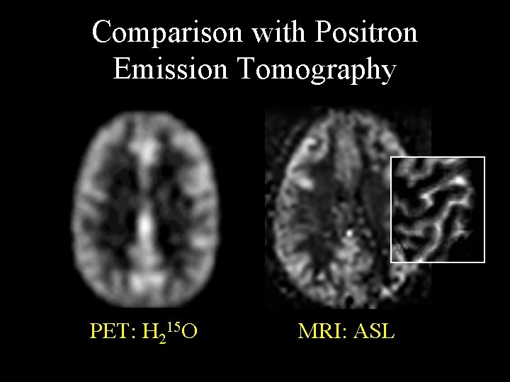 Comparison with Positron Emission Tomography PET: H 215 O MRI: ASL 