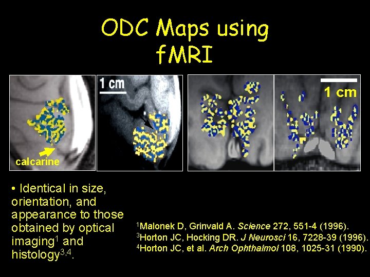 ODC Maps using f. MRI 1 cm calcarine • Identical in size, orientation, and
