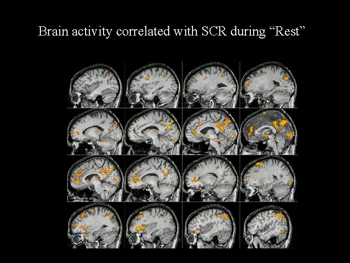 Brain activity correlated with SCR during “Rest” 