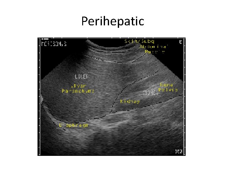 Perihepatic 