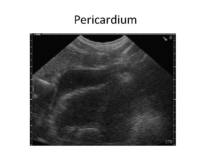 Pericardium 