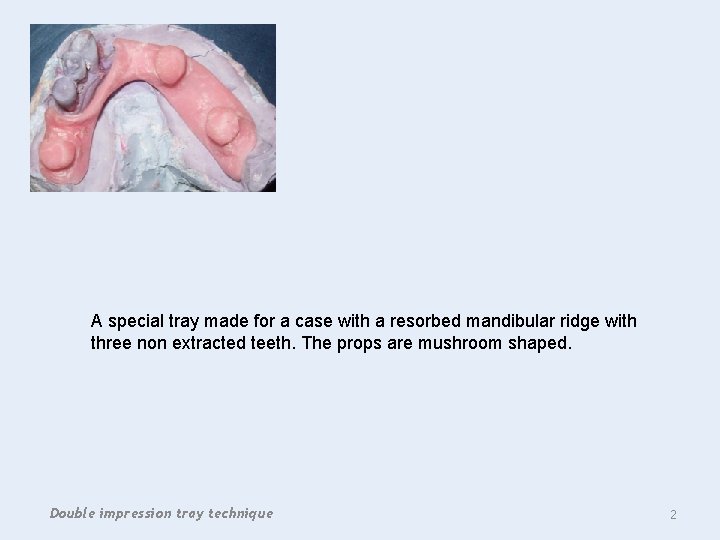 A special tray made for a case with a resorbed mandibular ridge with three