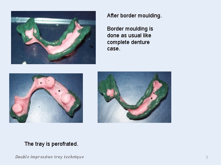 After border moulding. Border moulding is done as usual like complete denture case. The