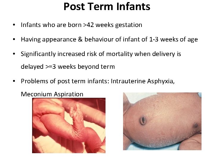 Post Term Infants • Infants who are born >42 weeks gestation • Having appearance